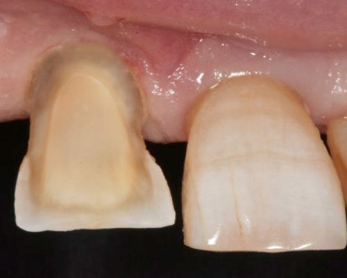 protesi-fissa-26