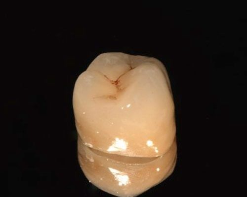 protesi-fissa-6
