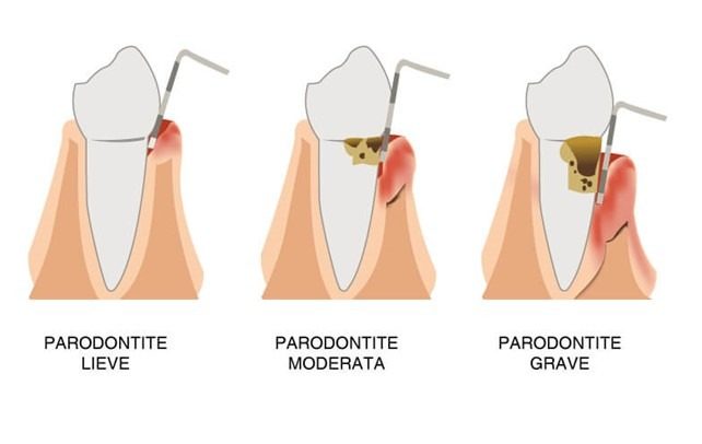 Tipologie e stadi della parodontite