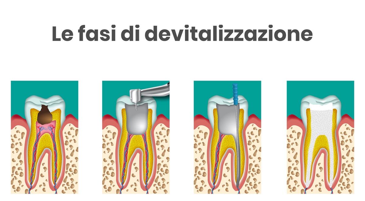 Devitalizzazione del dente: come funziona e quando è necessaria