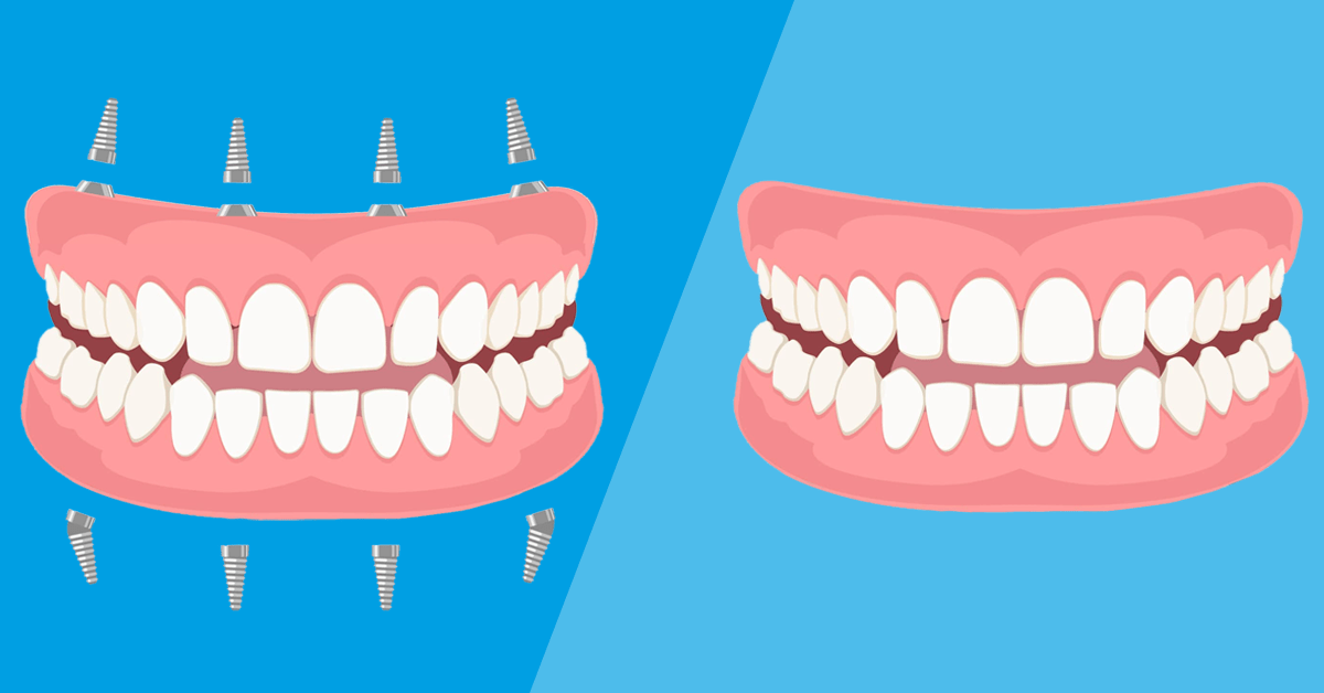 Protesi dentarie fisse o mobili: quale scegliere?