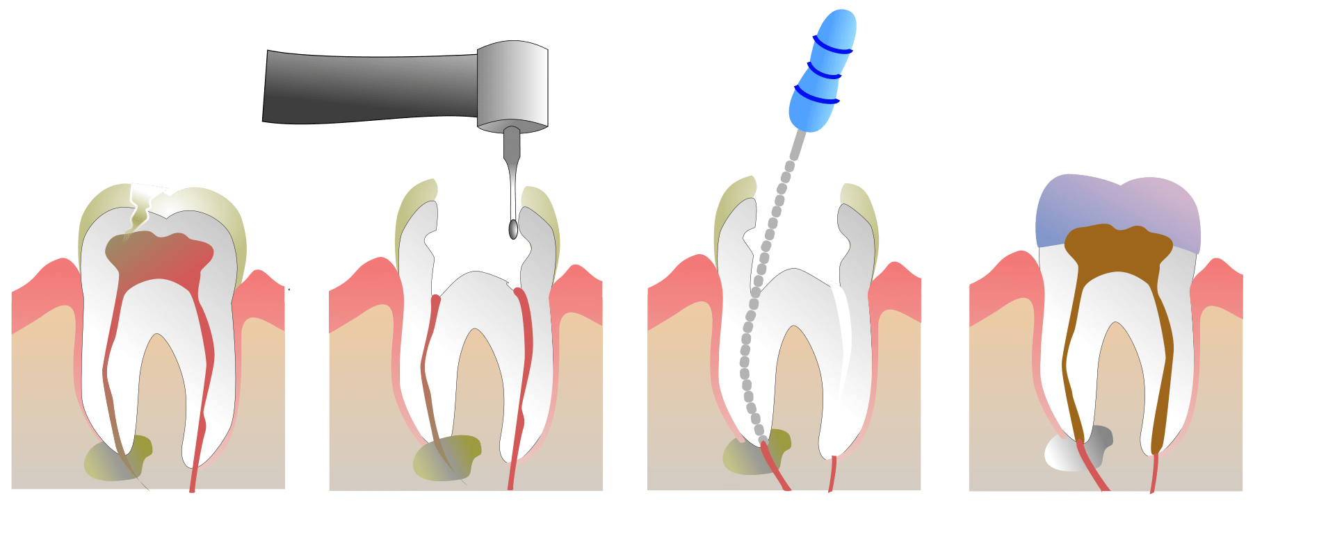 Devitalizzazione di un dente: quando serve davvero e cosa aspettarsi