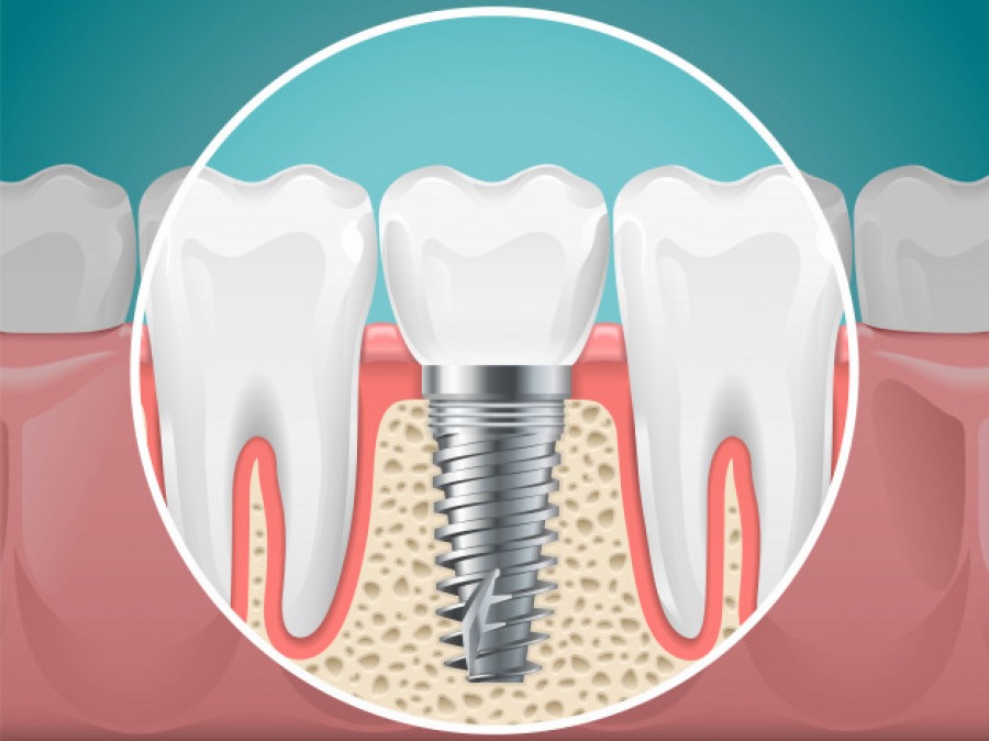 Impianti dentali: come funzionano e quando sono la soluzione giusta