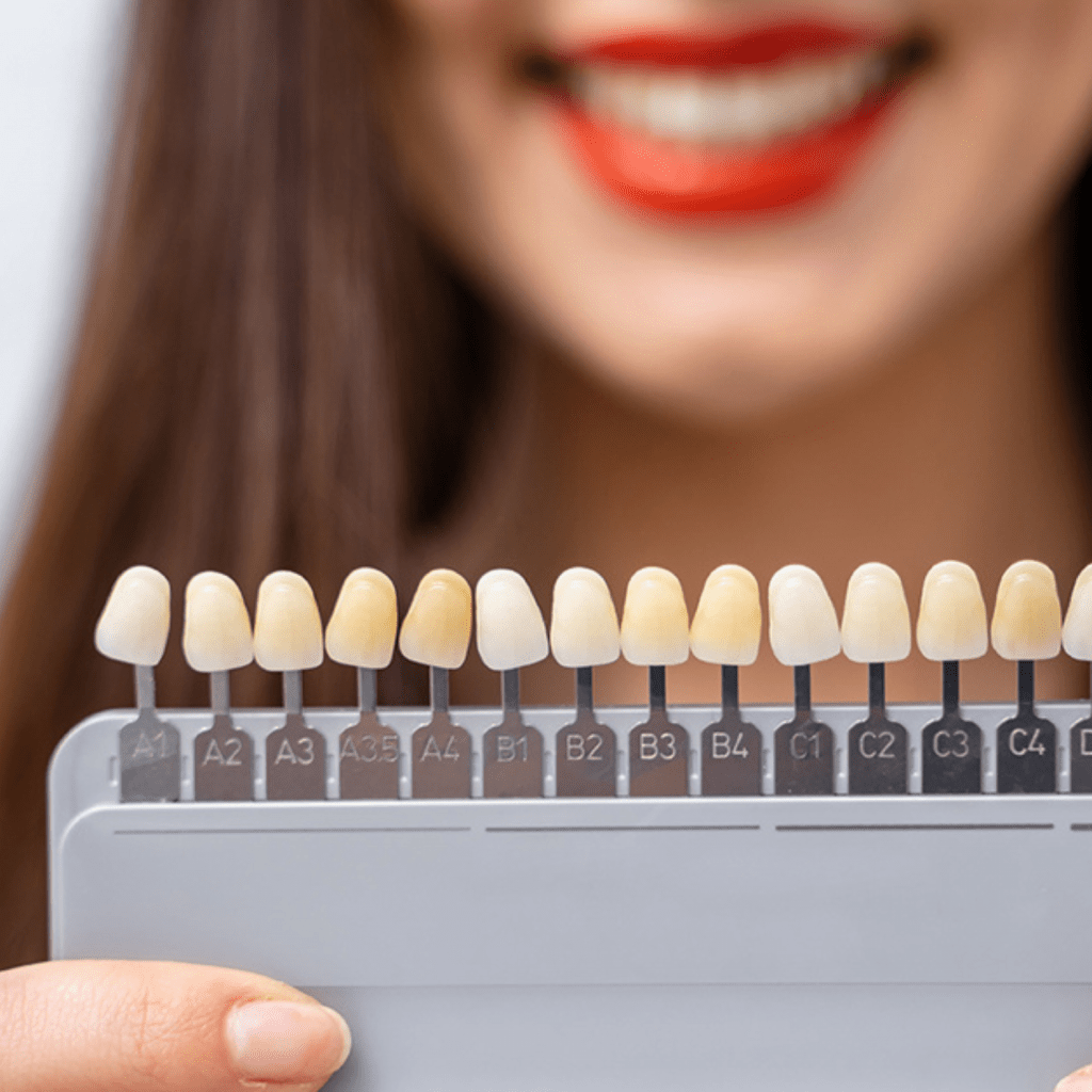 Sbiancamento dentale professionale: come funziona e quanto dura